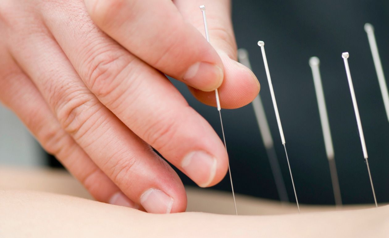 Sesiones de Acupuntura
